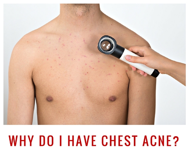 chest acne causes