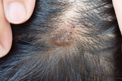 Ulcers on the scalp: 9 causes, symptoms and effective home remedies (2023)