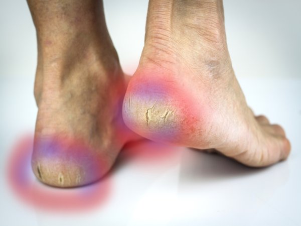get rid of thick skin on feet